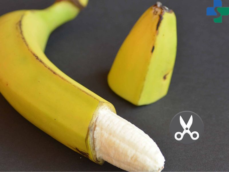 Cắt bao quy đầu xử lý hẹp bao quy đầu