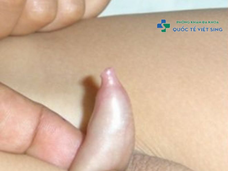 dấu hiệu hẹp bao quy đầu ở trẻ