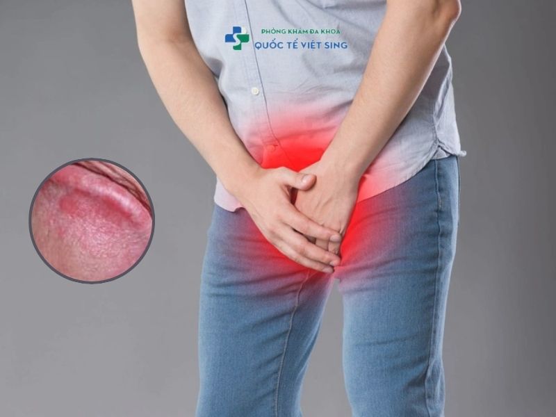 Dấu hiệu bệnh ở giai đoạn nhẹ