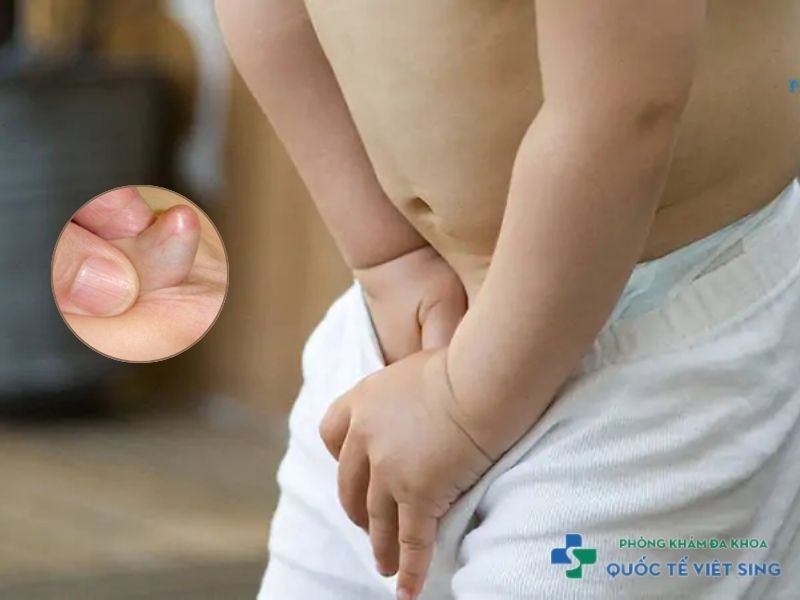 Hẹp bao quy đầu ở trẻ có thể dẫn đến viêm bao quy đầu
