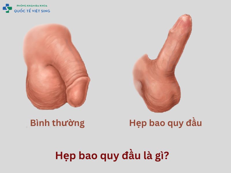 Hẹp bao quy đầu là gì?