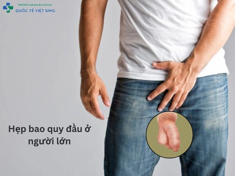 Hẹp bao quy đầu ở người lớn