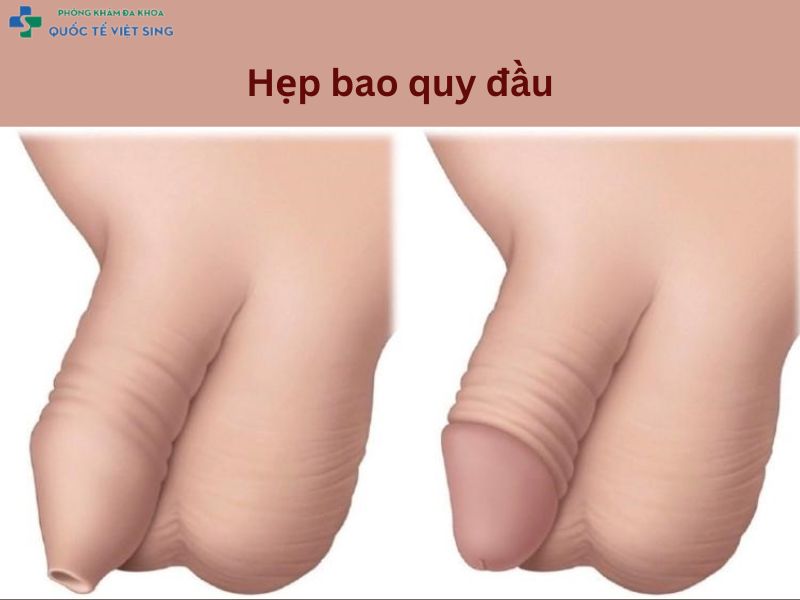 Hẹp bao quy đầu
