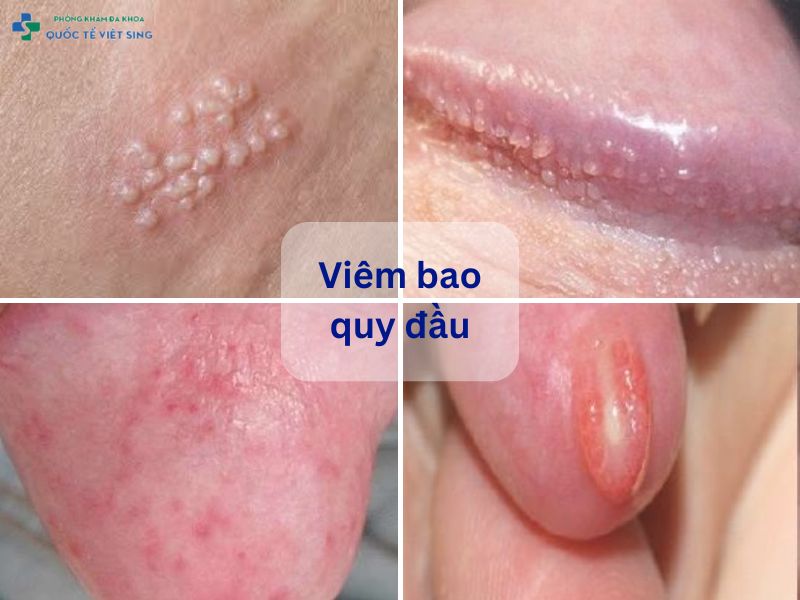 Hình ảnh viêm bao quy đầu