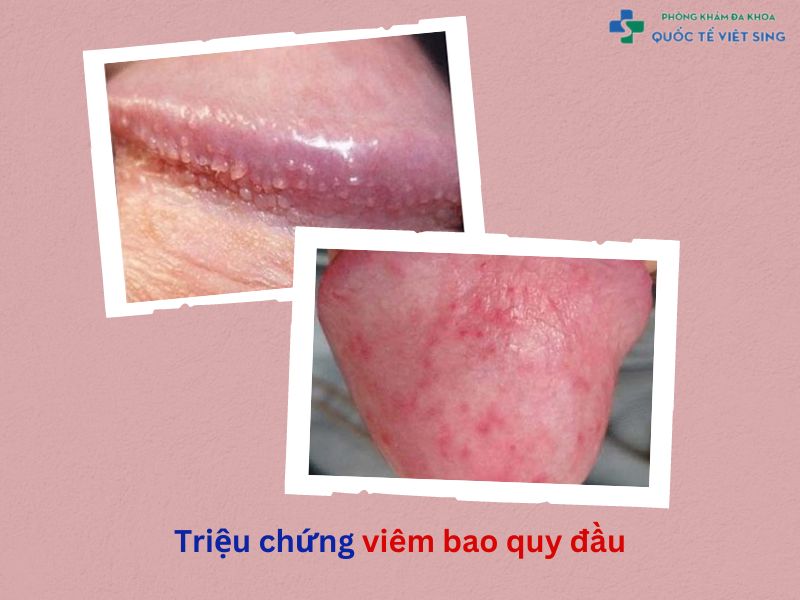 Triệu chứng viêm bao quy đầu